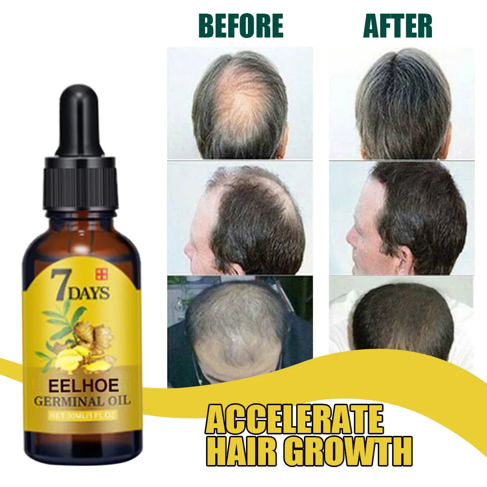 Ginger Hair Growth Serum - Anti-Hair Loss & Baldness Treatment - Fast Regrowth Hair Care Oil for Men & Women