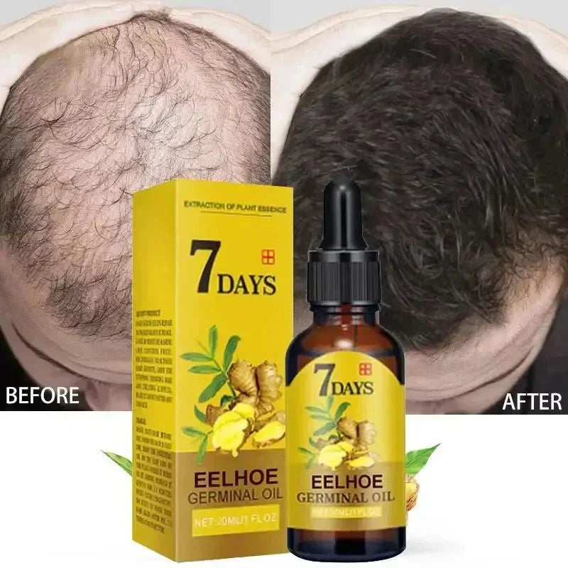 Ginger Hair Growth Serum - Anti-Hair Loss & Baldness Treatment - Fast Regrowth Hair Care Oil for Men & Women