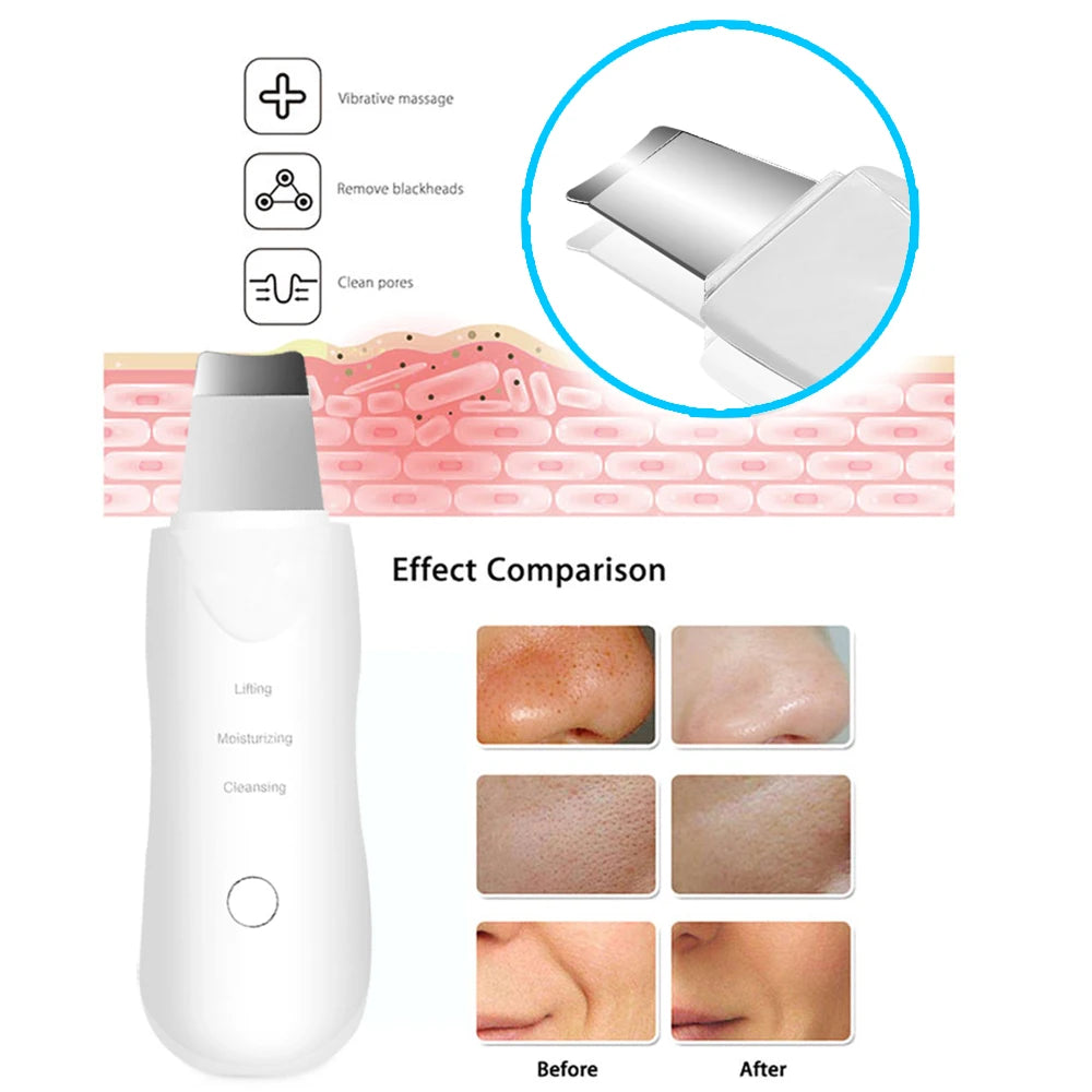 Ultrasonic Skin Scrubber Facial Cleaner - Blackhead Remover, Peeling & Massager