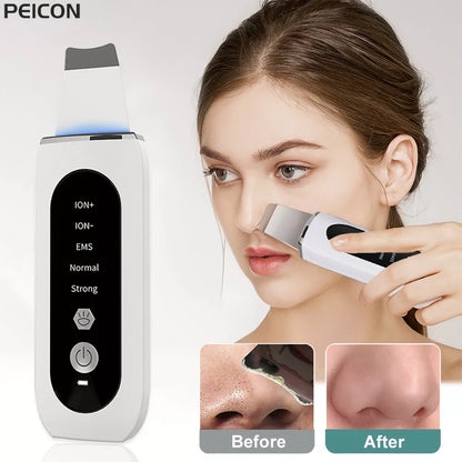 Ultrasonic Skin Scrubber - Blackhead Remover, Peeling & Pore Cleaner with Ion & Vibration Massage