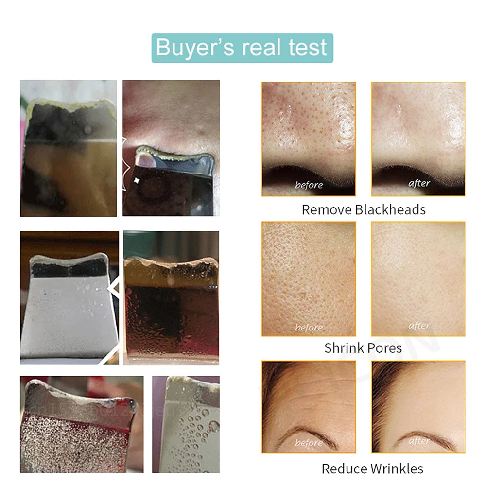Ultrasonic Skin Scrubber - Blackhead Remover, Peeling & Pore Cleaner with Ion & Vibration Massage